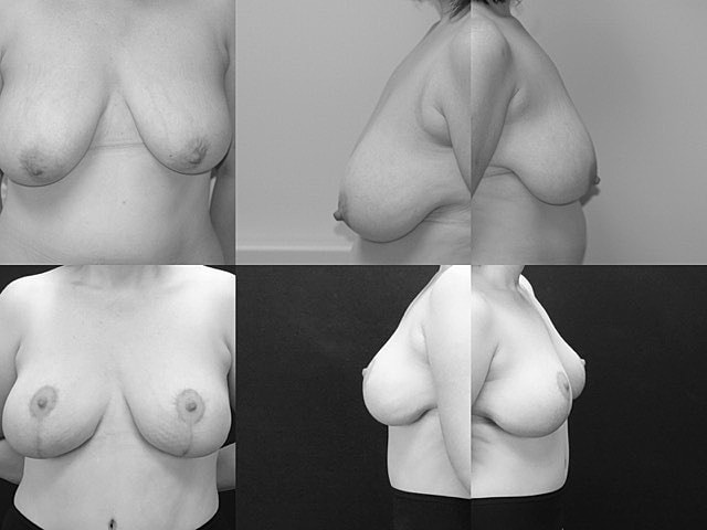 Mommy Makeover Before & After