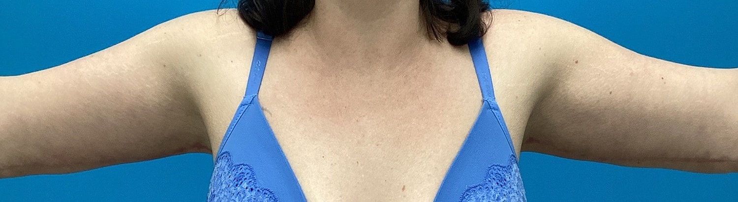 Brachioplasty Before & After
