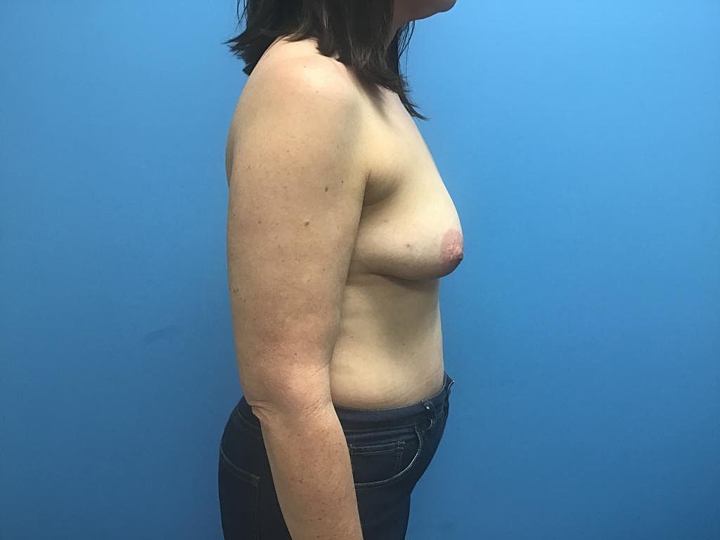 Breast Reconstruction Before & After