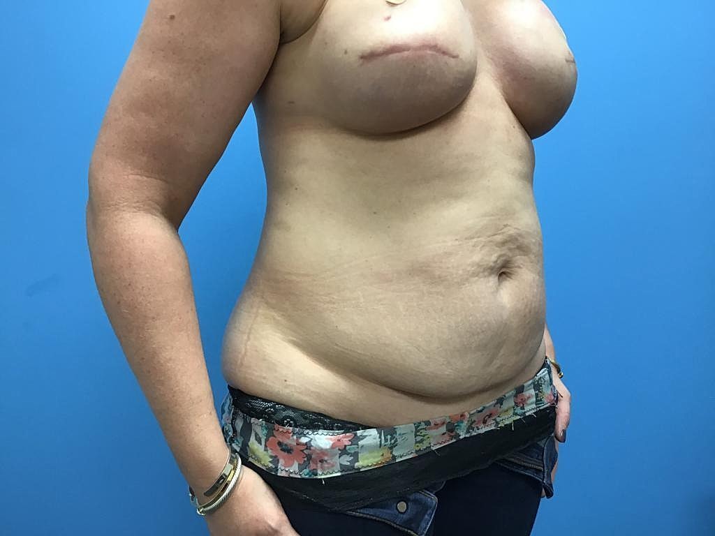 Breast Reconstruction Before & After