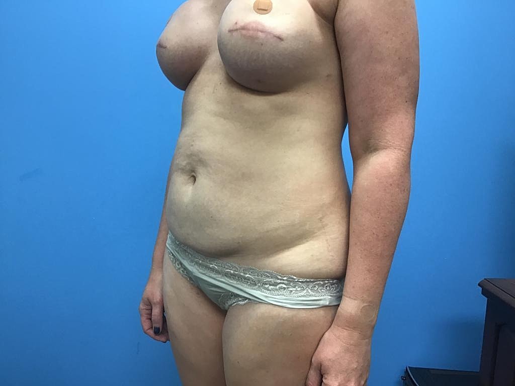 Breast Reconstruction Before & After