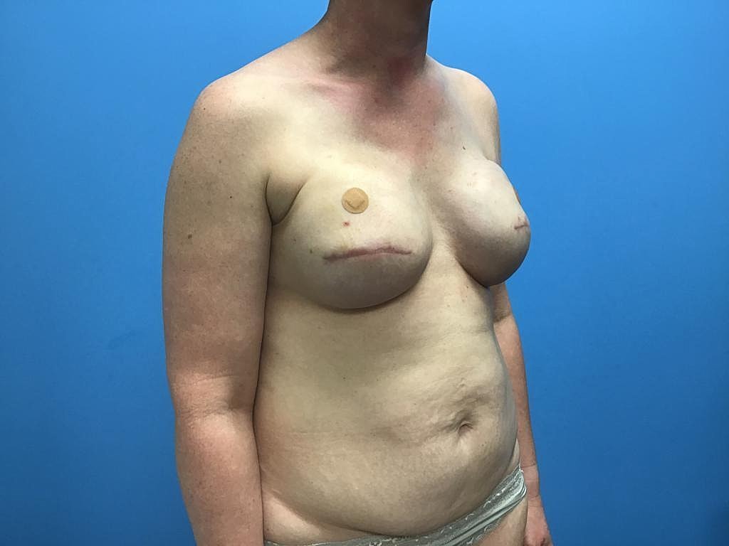 Breast Reconstruction Before & After