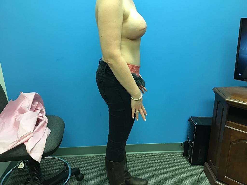 Breast Reconstruction Before & After