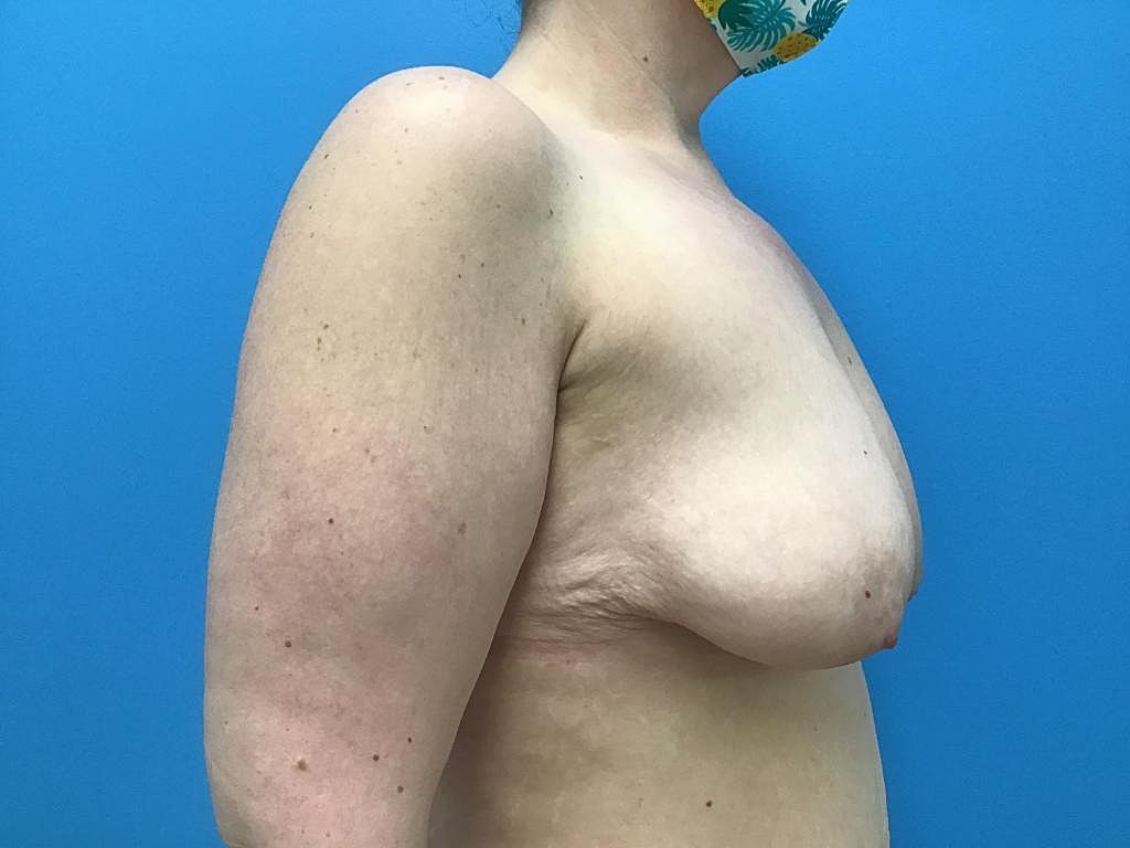 Breast Lift Before & After