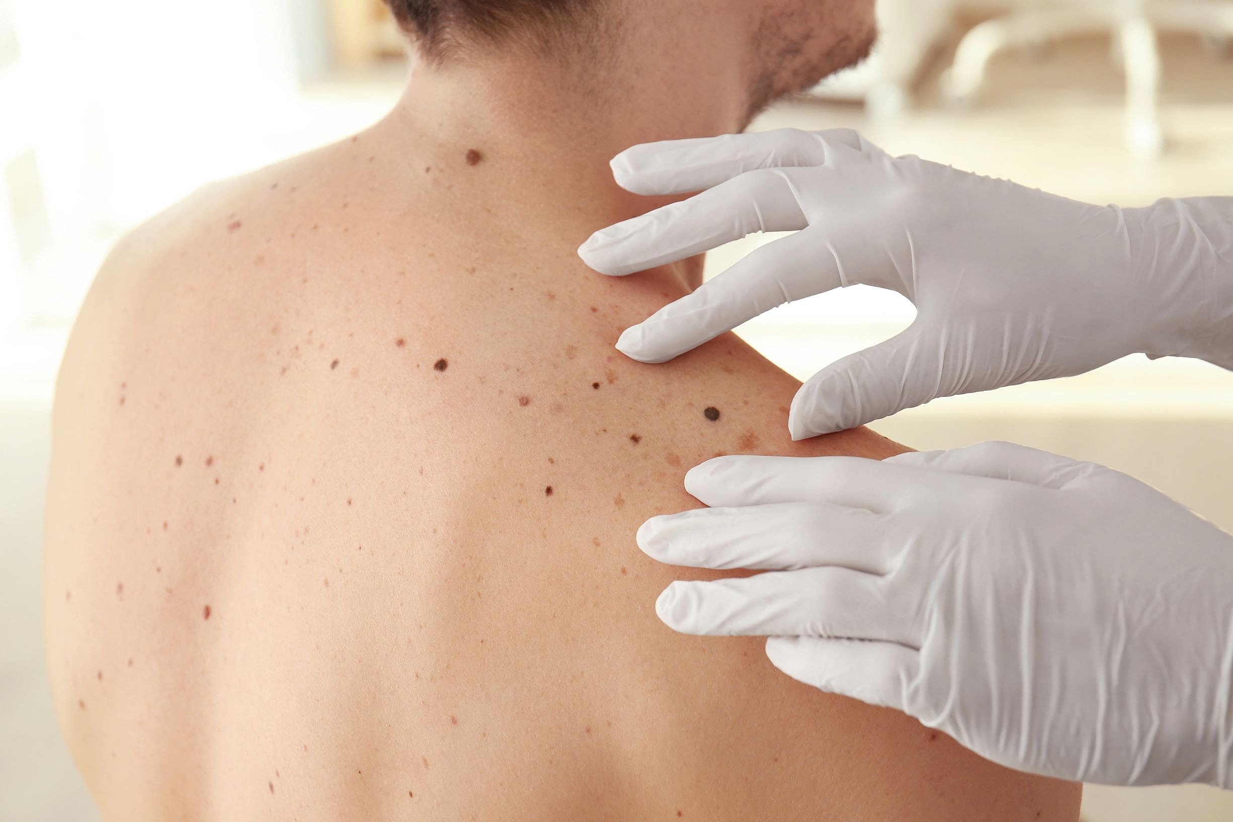 What to Expect During a Skin Check